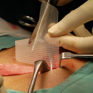 cirurgia-de-hernia-abdominal